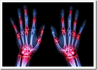 Rheumatoid Arthritis Solutions Amarillo TX