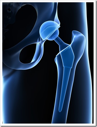 Back Pain Amarillo TX Joint Replacement