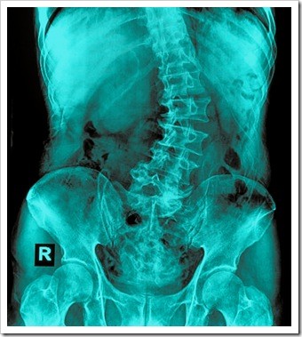 Scoliosis Amarillo TX Pain Relief