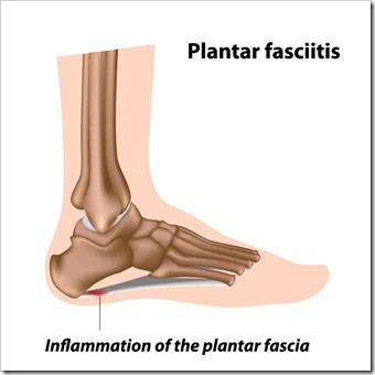Foot Pain Amarillo TX Plantar Fasciitis